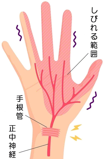 イラスト:症状が起こる範囲（PIXTA）