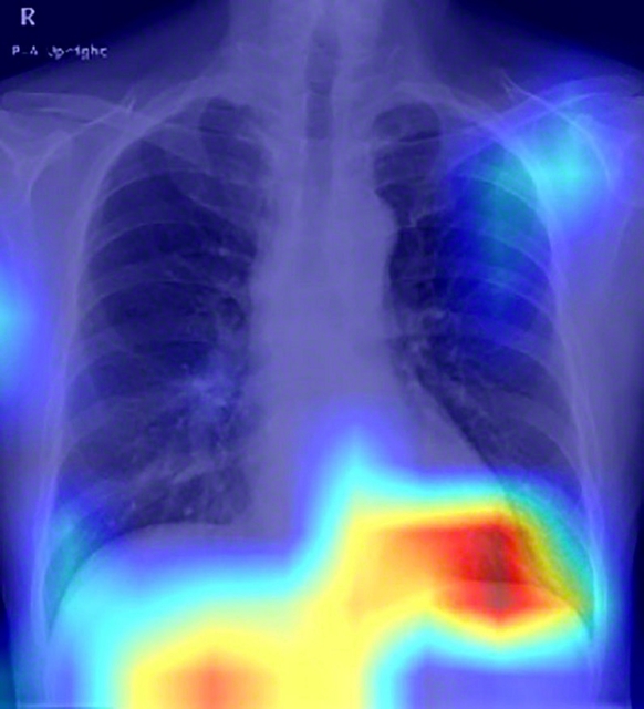 脂肪肝患者の胸部エックス線画像。AIモデルが脂肪肝の判別のためにより注目した部位が濃い赤で表示されている（大阪公立大学提供）