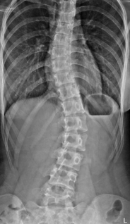 正面から見て本来ほぼ真っすぐである脊柱が、右に曲がっている（Medical　and　Travel/Shutterstock.com）