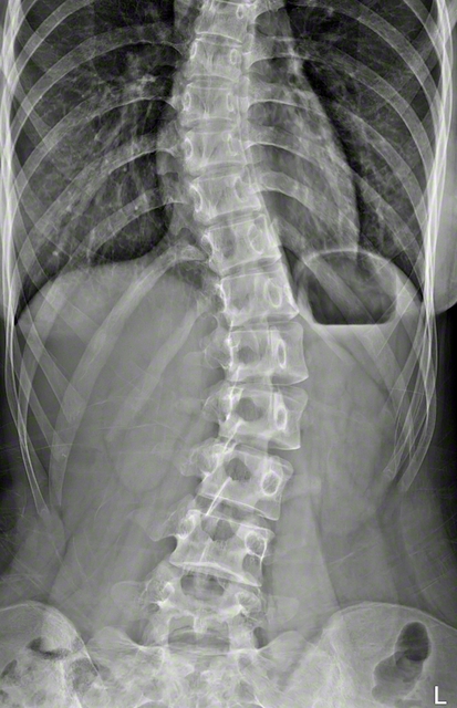 正面から見て本来ほぼ真っすぐである脊柱が、右に曲がっている（Medical　and　Travel/Shutterstock.com）