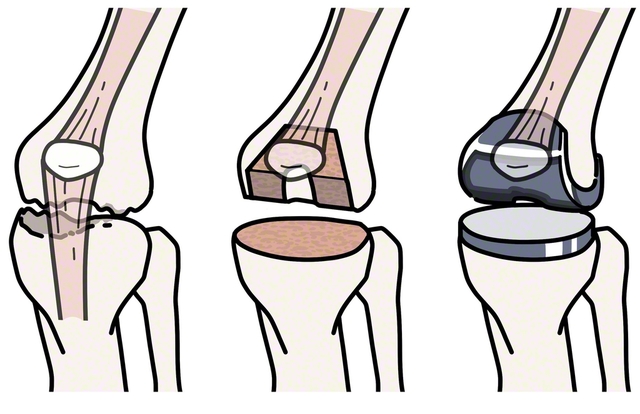 損傷がある膝関節⇨損傷部を切除⇨人工関節をかぶせる（PIXTA）