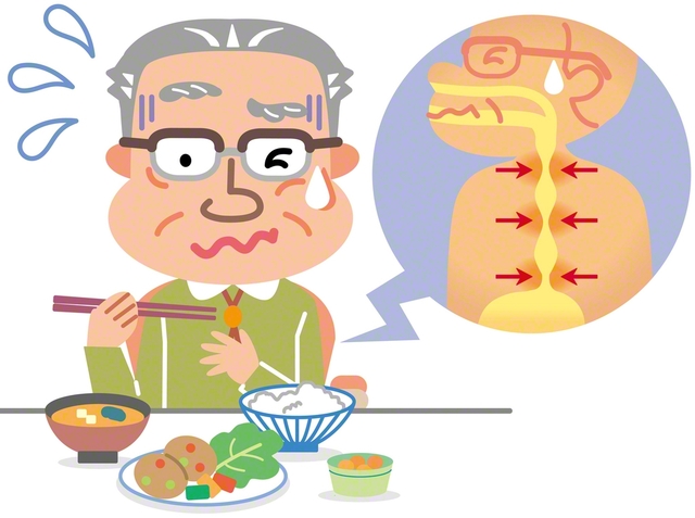 主要な症状は、喉の“つかえ”