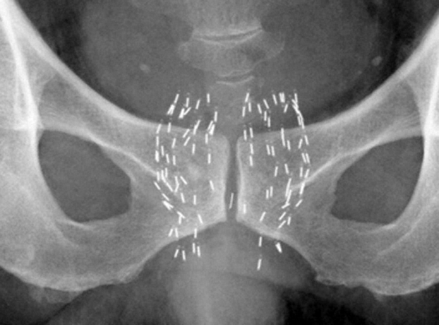 シード線源を埋め込んだ患者のエックス線写真。白く点在するのがシード線源
