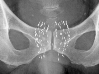 シード線源を埋め込んだ患者のエックス線写真。白く点在するのがシード線源