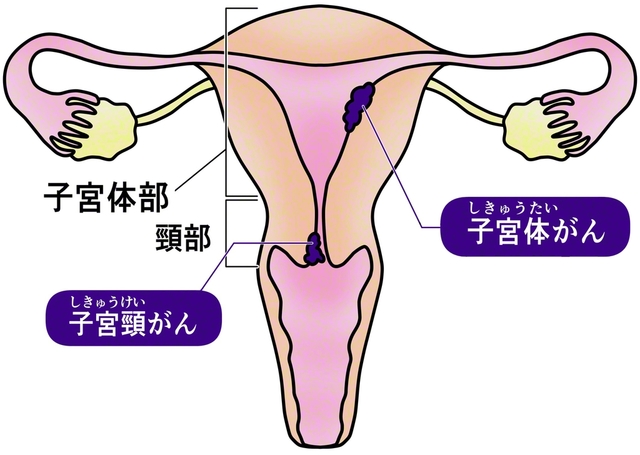 子宮のがんは、体部に発生する「子宮体がん」と、頸部に発生する「子宮頸がん」に分かれる。発生部位だけでなく、原因も治療法も異なっている（イラスト提供:nenta/イメージマート）