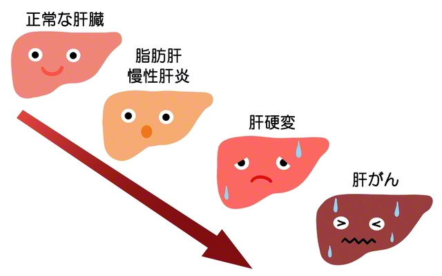 肝臓に脂肪が付くと、肝細胞に炎症が起こり、肝がんの発症リスクが上昇する。肝硬変になる前に発症する場合もある（PIXTA）