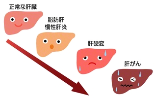 肝臓に脂肪が付くと、肝細胞に炎症が起こり、肝がんの発症リスクが上昇する。肝硬変になる前に発症する場合もある（PIXTA）
