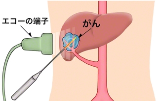 アブレーション