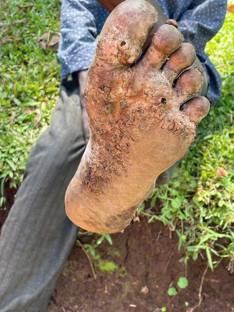 スナノミ症患者の足裏